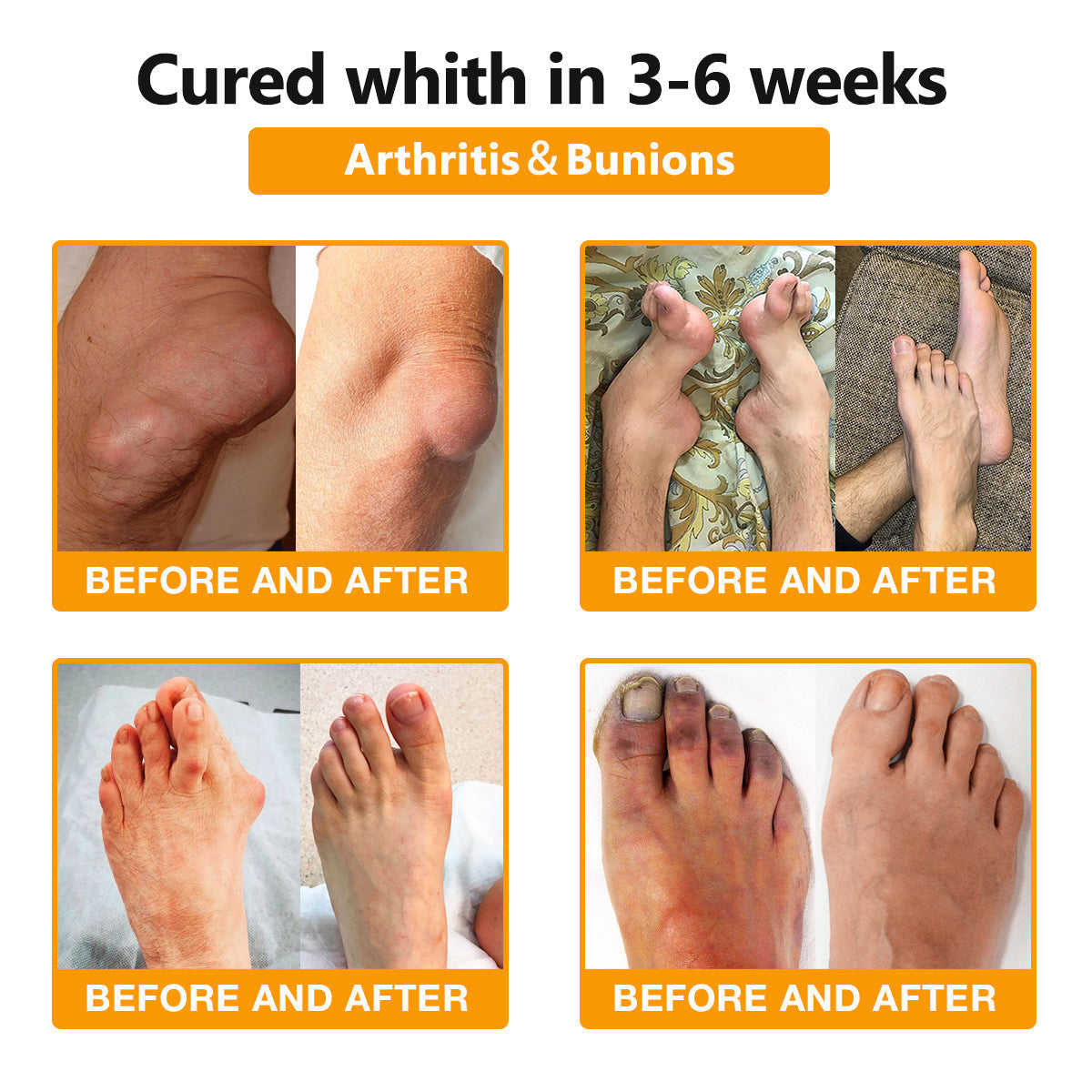 Furzero™🧊 Bee Venom & Turmeric Joint and Bone Pain Relief Cream (Specializes in Joint and Arthritis Pain & AAOS Recommends)