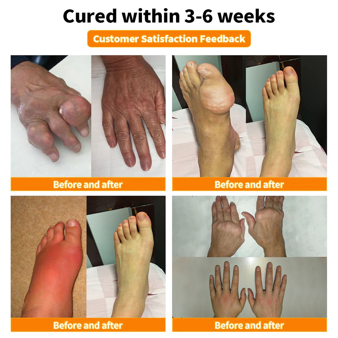 Furzero™🧊 Bee Venom & Turmeric Joint and Bone Pain Relief Cream (Specializes in Joint and Arthritis Pain & AAOS Recommends)