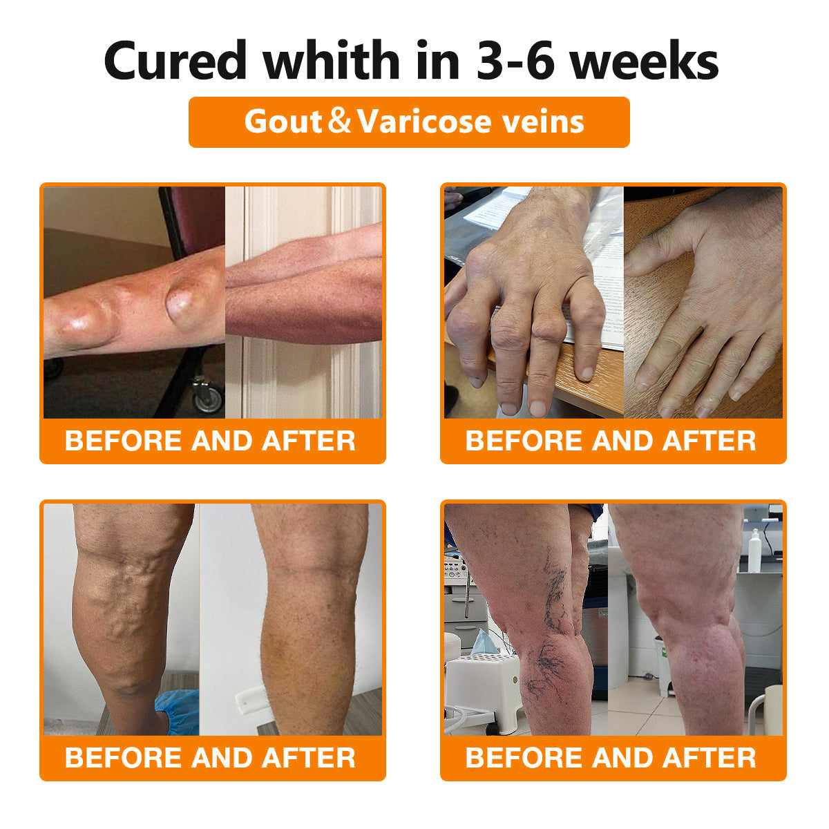 Furzero™🧊 Bee Venom & Turmeric Joint and Bone Pain Relief Cream (Specializes in Joint and Arthritis Pain & AAOS Recommends)