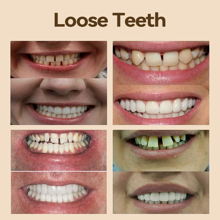 𝐇𝐢𝐝𝐨𝐧𝐞® 💎- 𝐏𝐫𝐞𝐦𝐢𝐮𝐦 𝐃𝐞𝐧𝐭𝐮𝐫𝐞- (✨Suitable for all mouth shapes, custom-made dentures for a perfect fit✨)