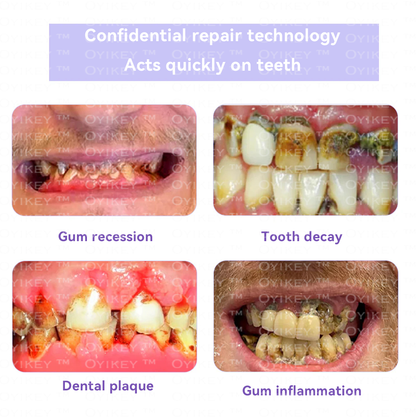 Oyikey™🍀 TOOTH RESTORATION MINERAL POWDER(BDA recommended)